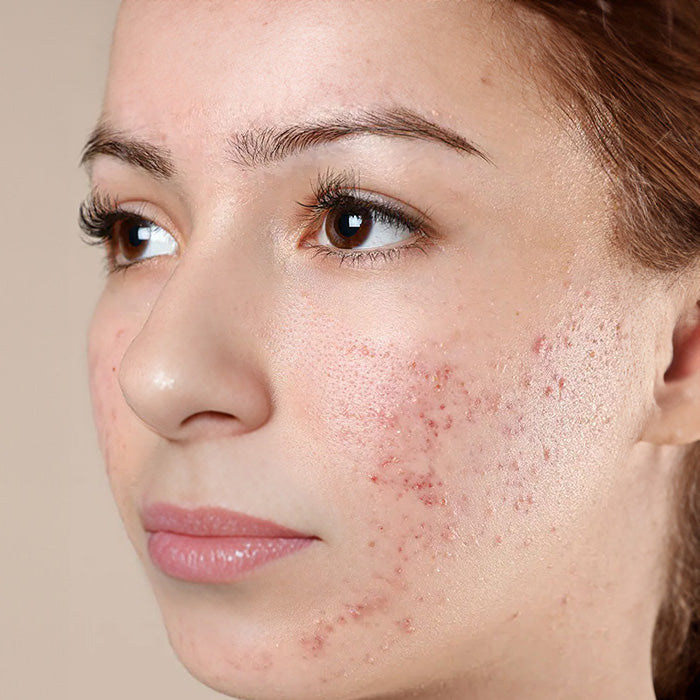 clear ance with faradbeauty mask